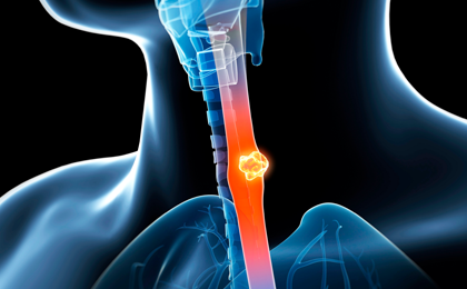 for Esophageal Cancer