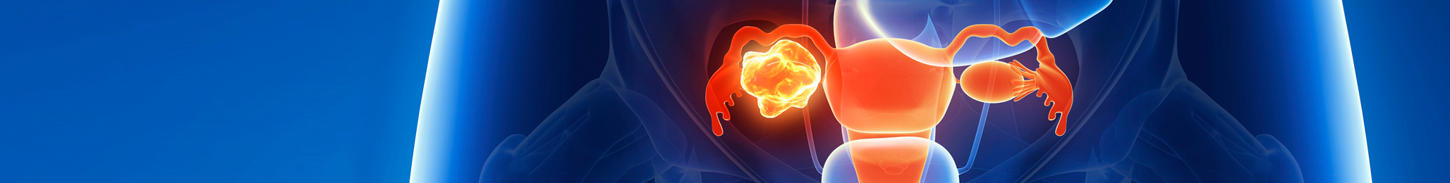 Ovarian Cancer