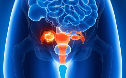 Image for Ovarian Cancer