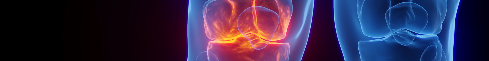 Tenosynovial Giant Cell Tumor