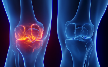 for Tenosynovial Giant Cell Tumor